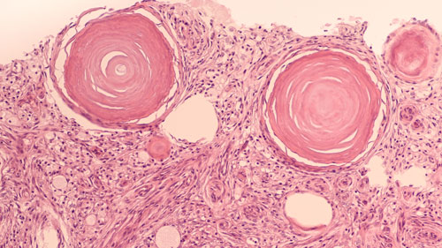 Image of Psammoma bodies in cells